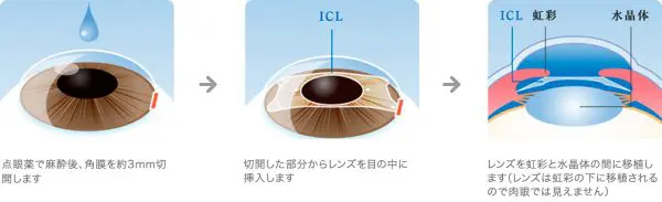 Icl 眼内コンタクトレンズ 費用と特徴